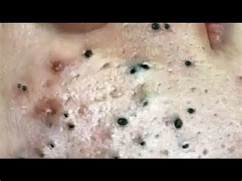 blackhead removal - youtube|new 2023 blackhead removal videos.